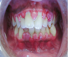 Periodontal disease, periodontitis in delhi, dentist, Gingivitis, dentist, mouth rehabilitation