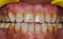 Cosmetic Dentistry Treatment in Hauz Khas
